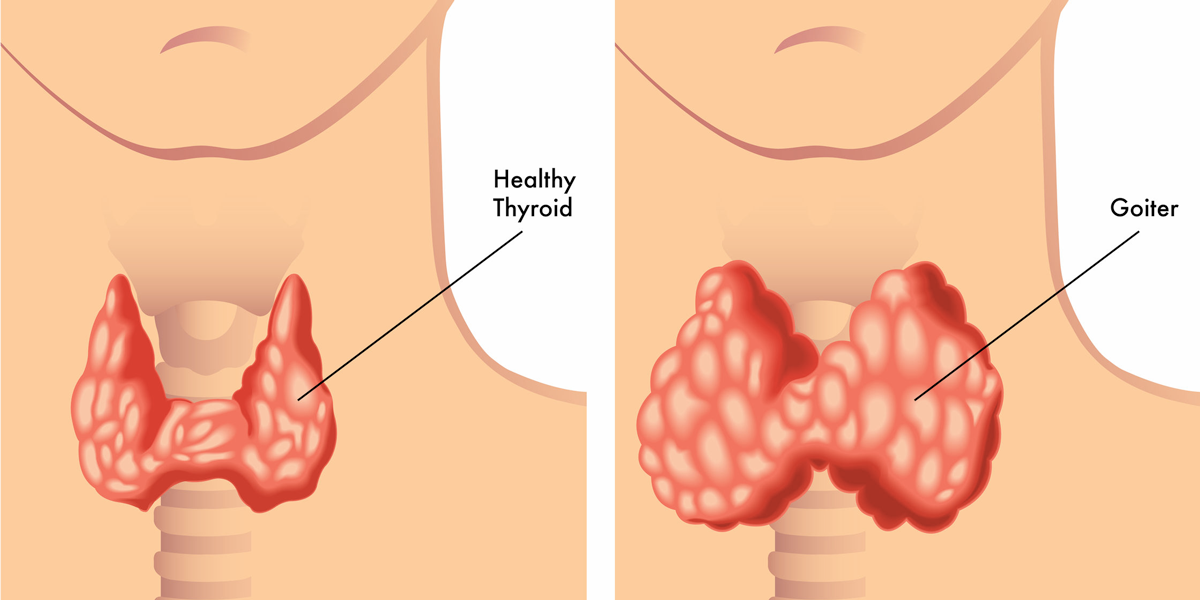 normal and enlarged thyroid